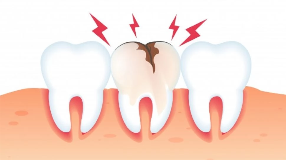 Penyebab Sakit Gigi Berlubang yang Perlu Diketahui